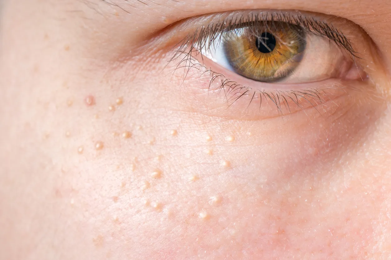 Milia (Milium) pimples around eye on skin.
