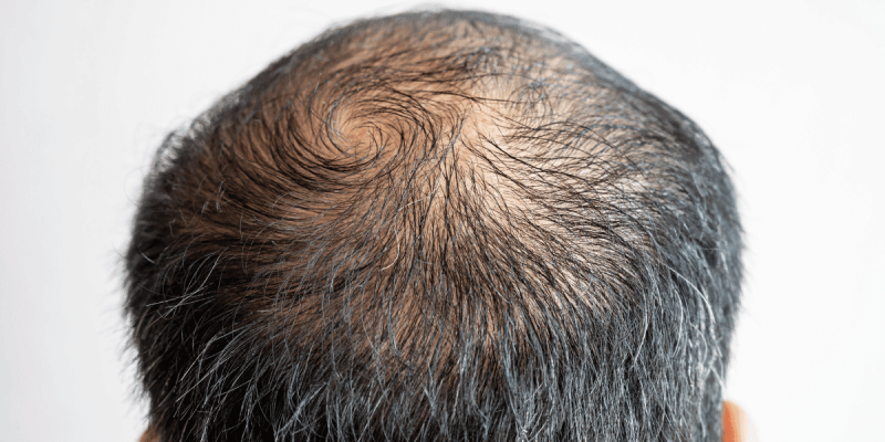 Hair Loss Treatment