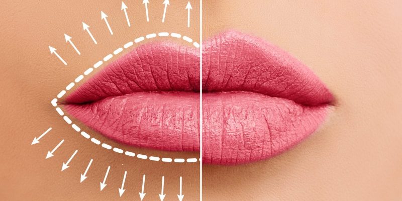 Lip Filler