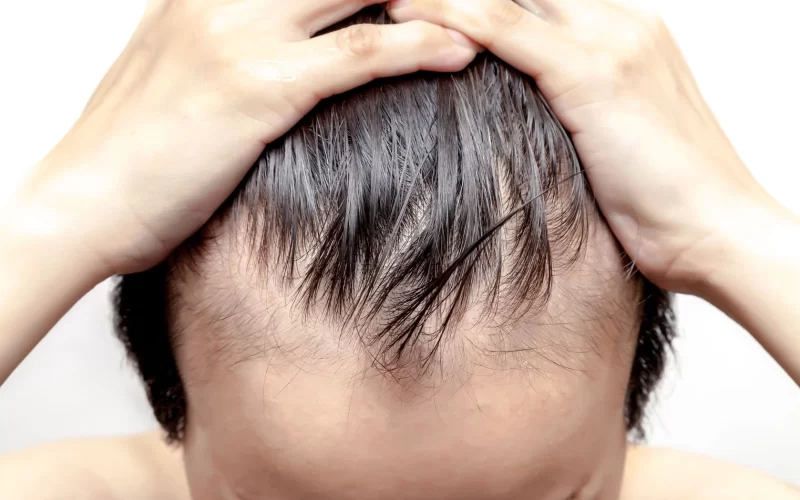 Luxura Med Spa Chicago Male Hair Thinning