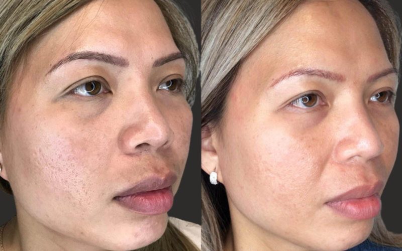 Radiofrequency Microneedling Chicago Med Spa