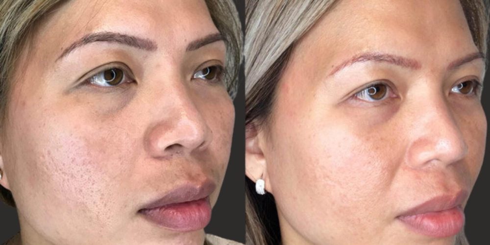 Radiofrequency Microneedling Chicago Med Spa Radiofrequency Microneedling Chicago Med Spa