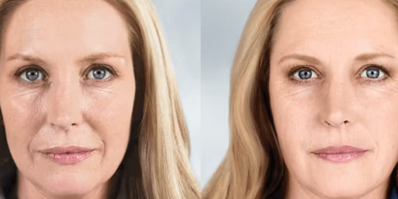 Sculptra chicago med spa