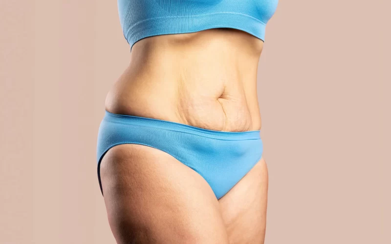 Weight Loss Loose Skin Treatment Med Spa Chicago