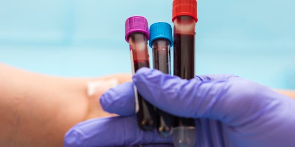 nurse holding blood test vials in gloved hand